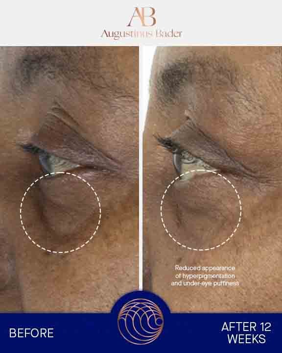 Augustinus Bader Augenpflege The Eye Cream Nomad (Refill)