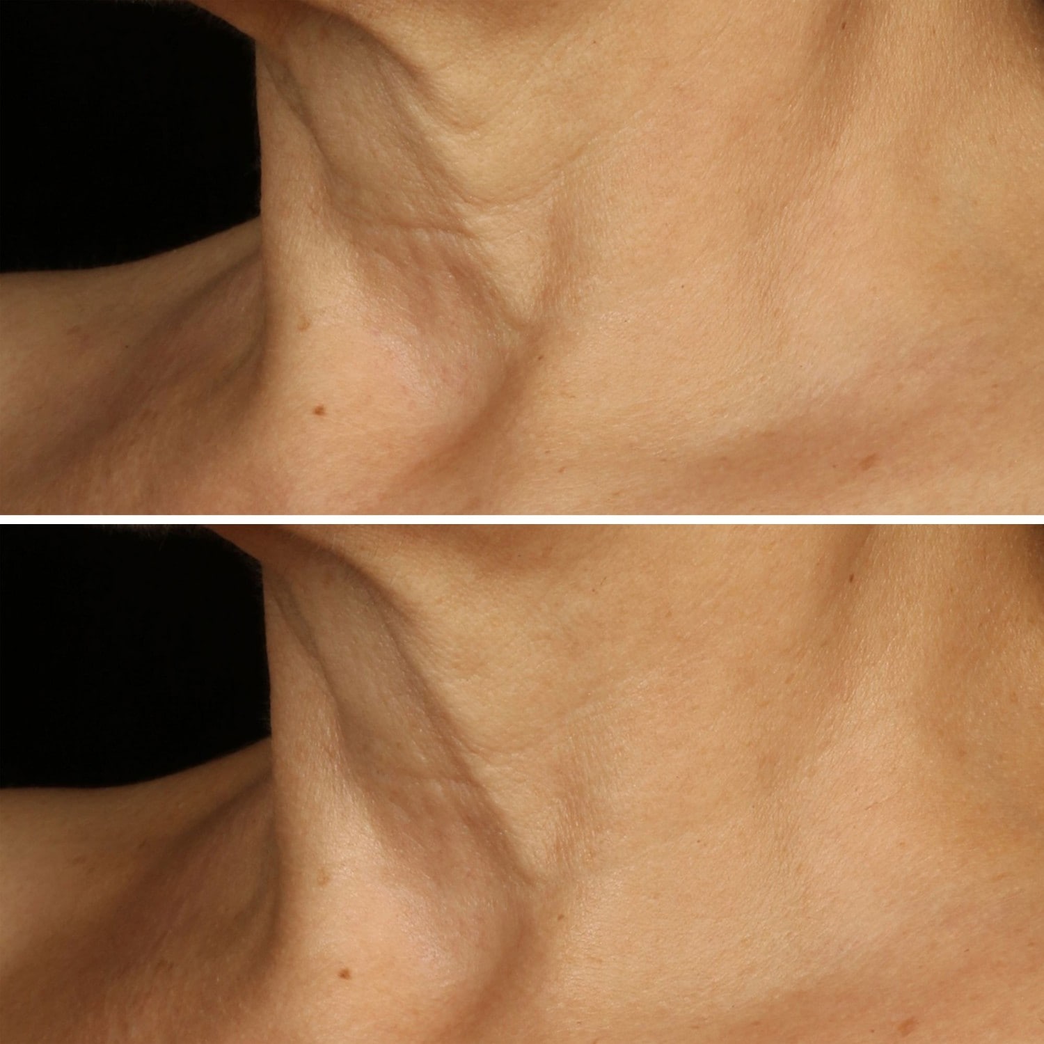 Clinique Lifting arc- és nyakkrém