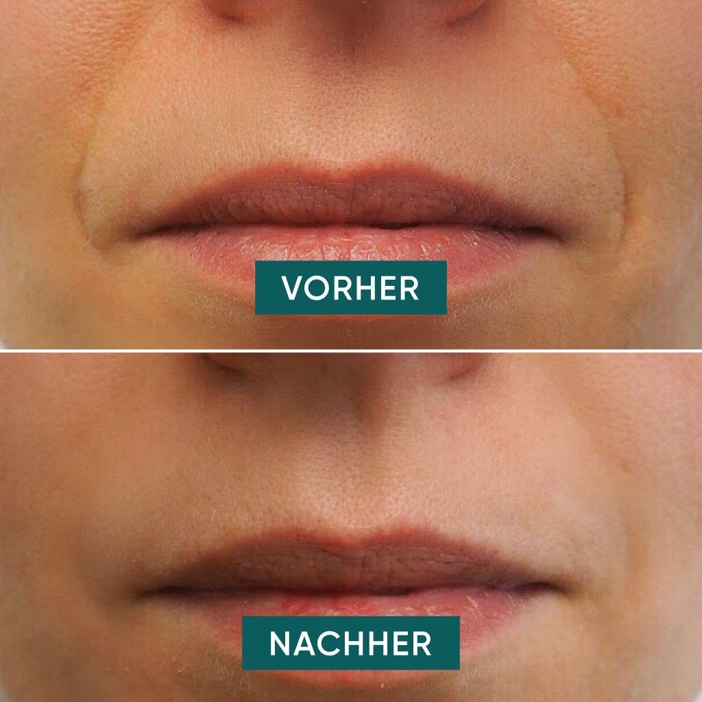APRICOT Beauty Gesichtsmaske APRICOT® Nasolabial Pads aus Silikon Hyaluron gegen Mimikfalten