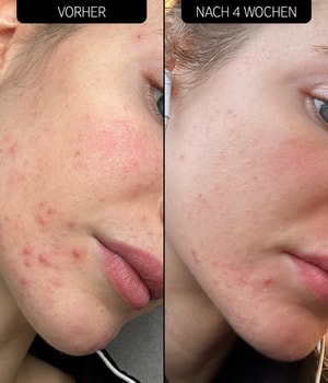 The INKEY List Blemish Clearing Moisturizer 2% NovoRetin Gesichtscreme-30 ml