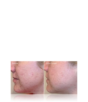 Murad Blemish Control Daily Clarifying Peel Pickeltupfer-30 ml
