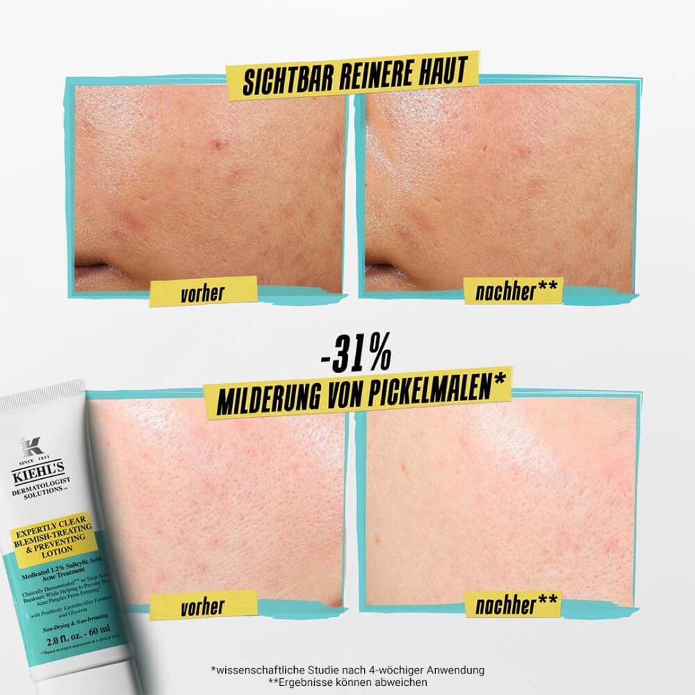 KIEHL&'S ACNE FULL FACE LOTION