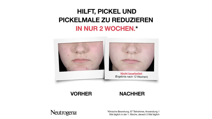 Neutrogena Anti-Pickel+ AHA/PHA/BHA Peeling Serum 30 ml
