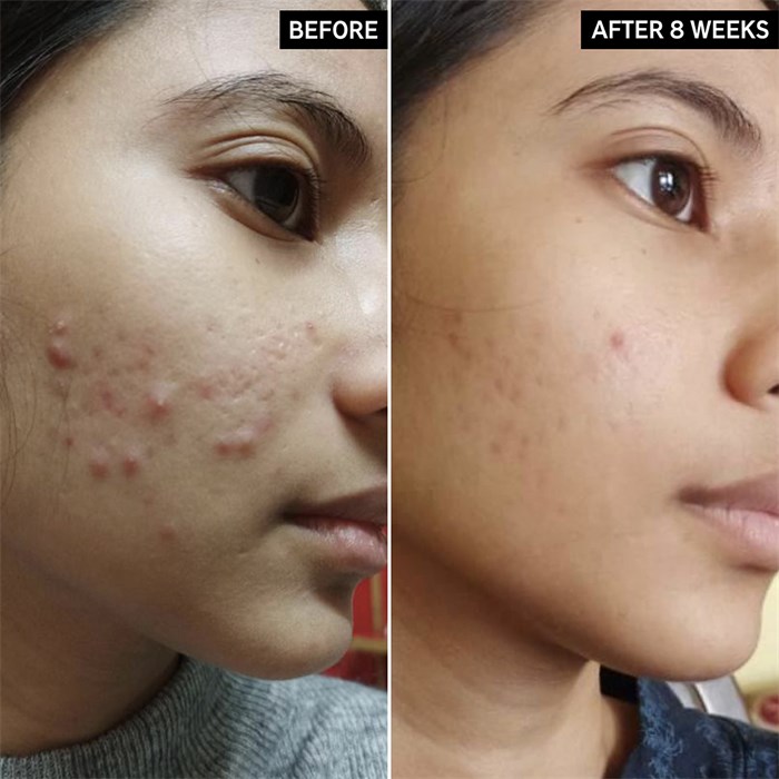 Salicylic Acid Cleanser