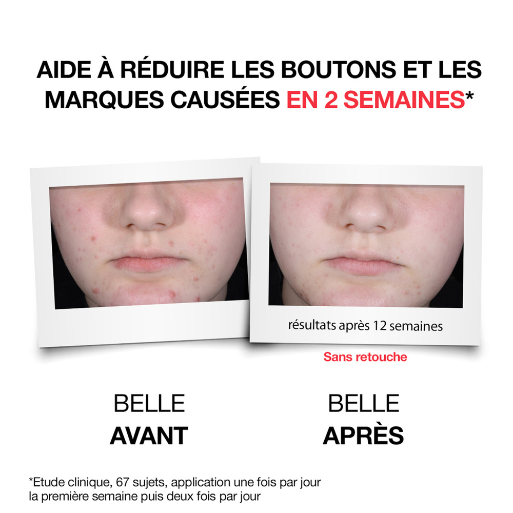 neutrogena Neutrogena Anti-boutons + Sérum Quotidien, Acide Salicylique, 1 Unité x 30 ml Sérum