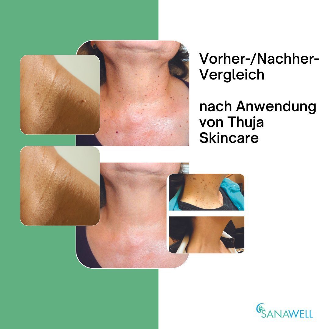 Medosan Warzen-Behandlungsstift Thuja Skincare-Fluid, 10ml mit Dosierpinsel