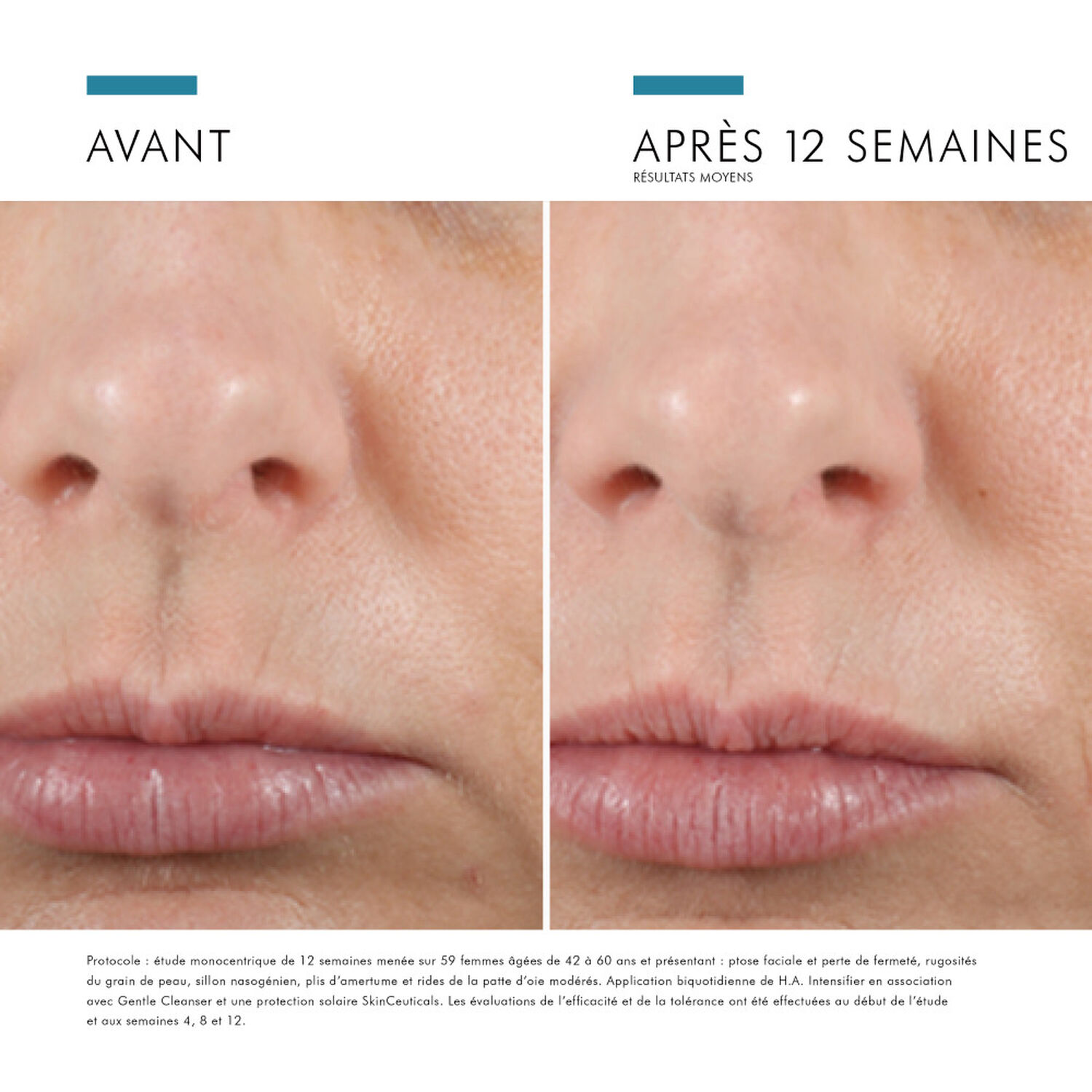 Skinceuticals H.A Intensifier Sérum Booster D'acide Hyaluronique 30 ml