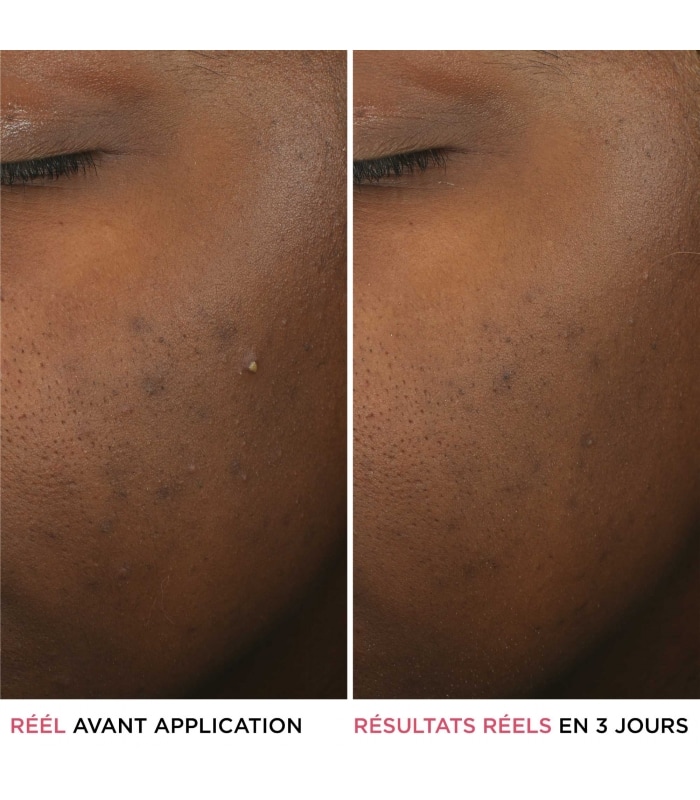 IT COSMETICS-BYE BYE BREAKOUT-Sérum anti-acné à l'acide salicylique