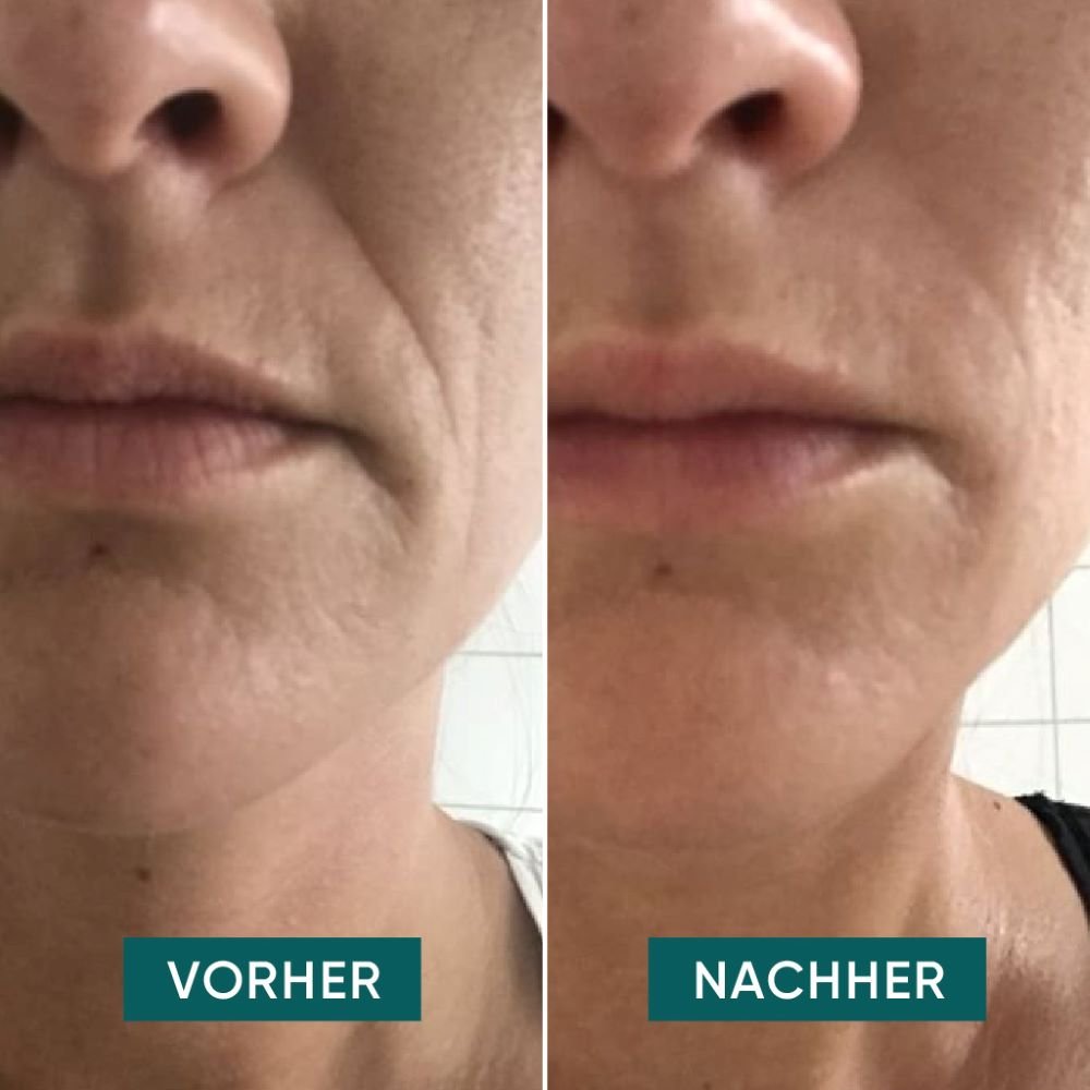 Apricot Beauty Pads Mund Pads mit Hyaluron