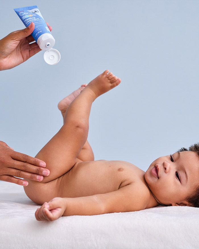 Pommade cicatrisante pour bébé : aide à traiter et à prévenir l’érythème fessier