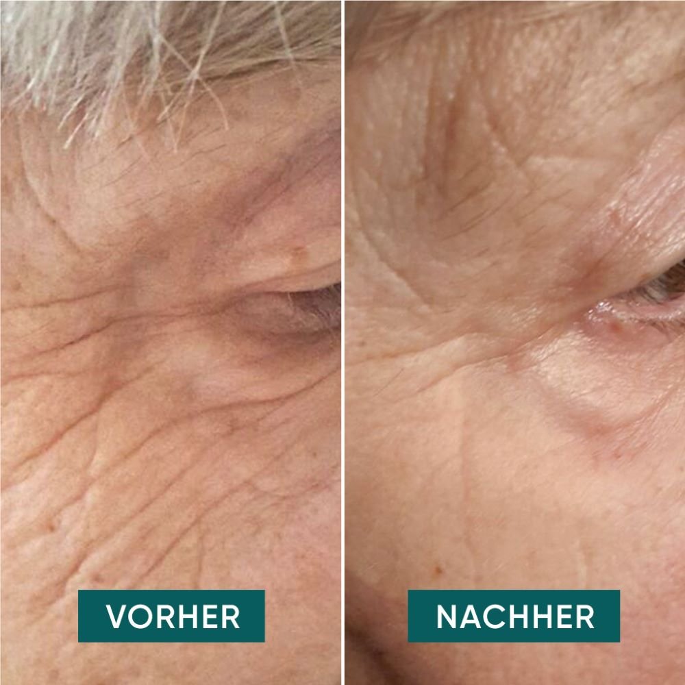 Apricot Beauty Pads Augen-Schläfen Pads mit Hyaluron