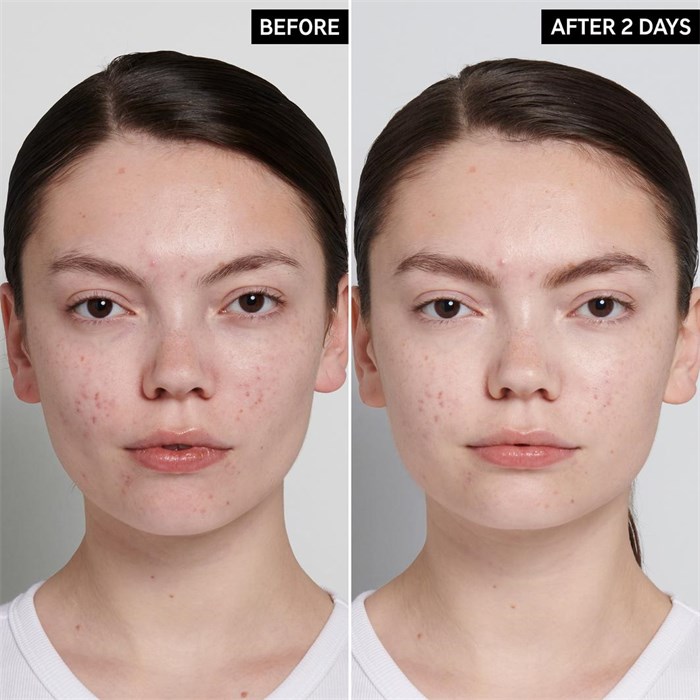 Succinic Acid Treatment
