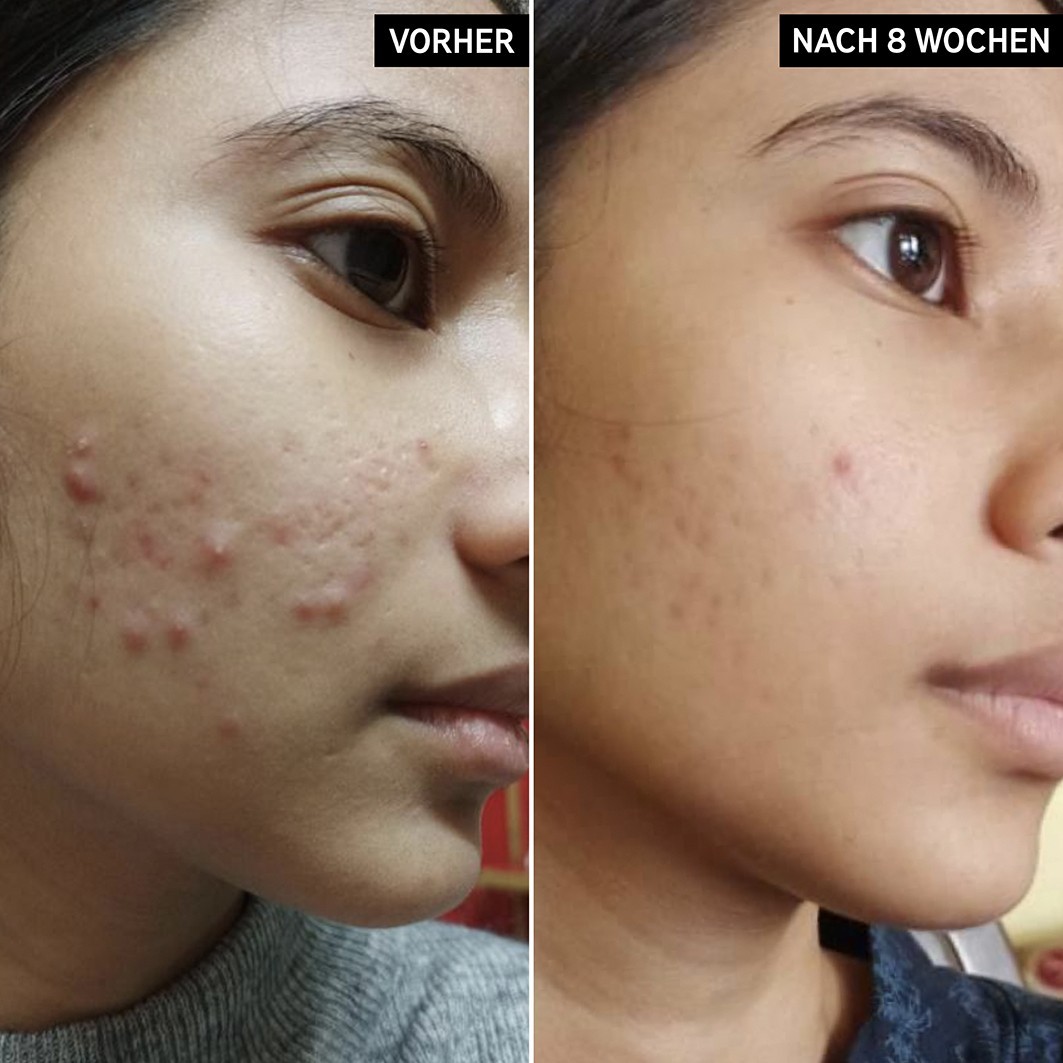 SALICYLIC ACID CLEANSER