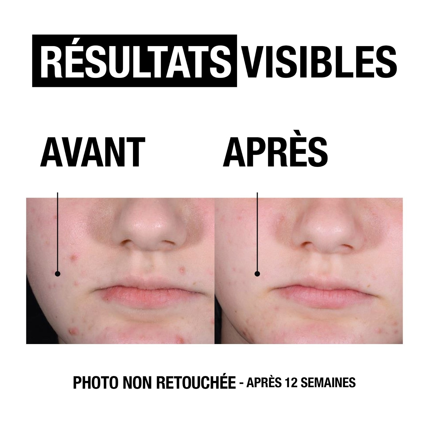 Neutrogena Anti-Pimples + Płynny peeling