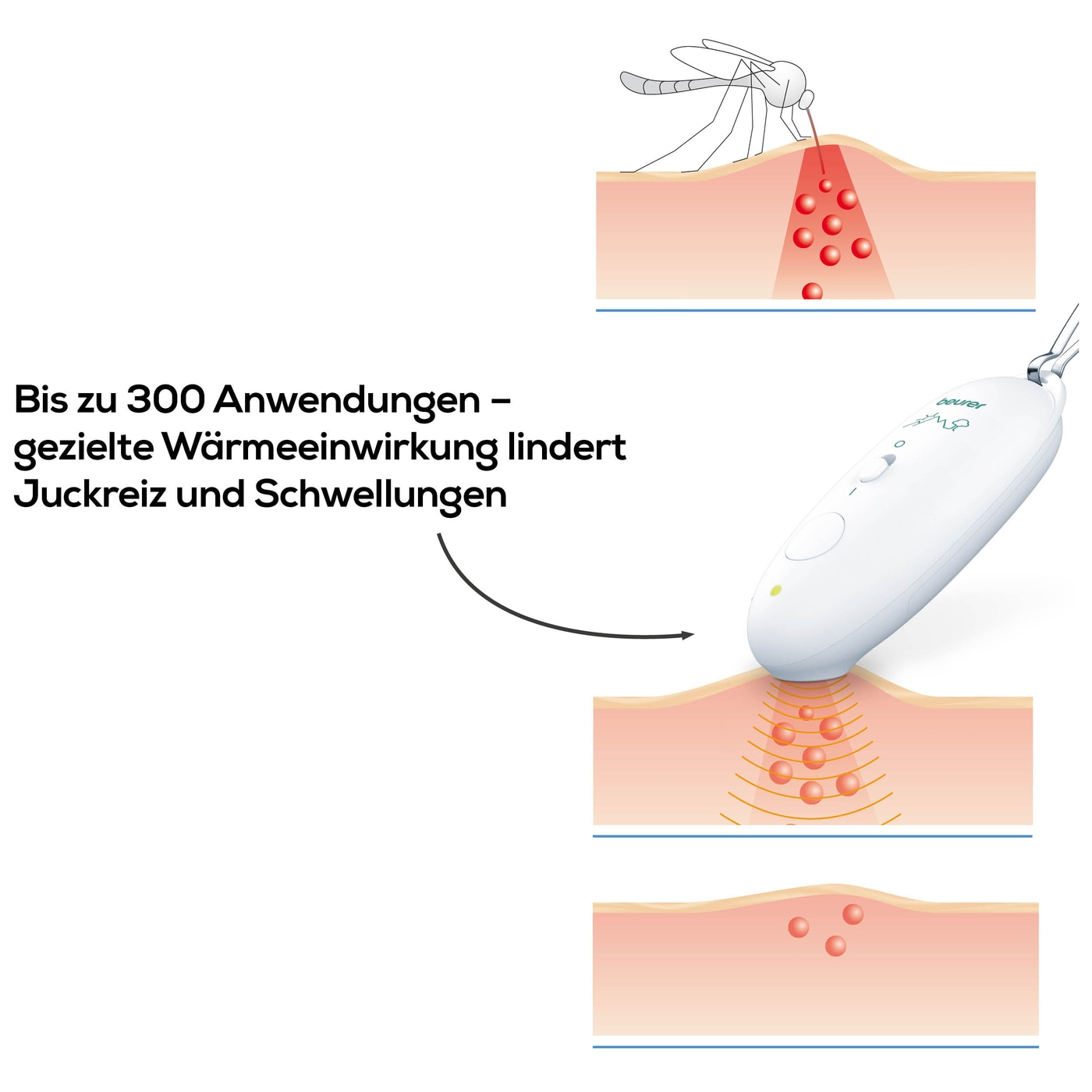 Beurer Insektenstichheiler BR 10-Stichheiler gegen Juckreiz & Schwellungen mit Karabinerhaken