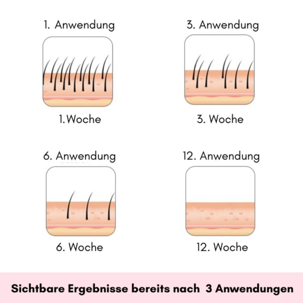 Wonder Skin IPL-Haarentferner IPL Hair Laser Pro (2 Modi), 500.000 Lichtimpulse, Dauerhafte Haarentfernung am ganzen Körper, schmerzfrei