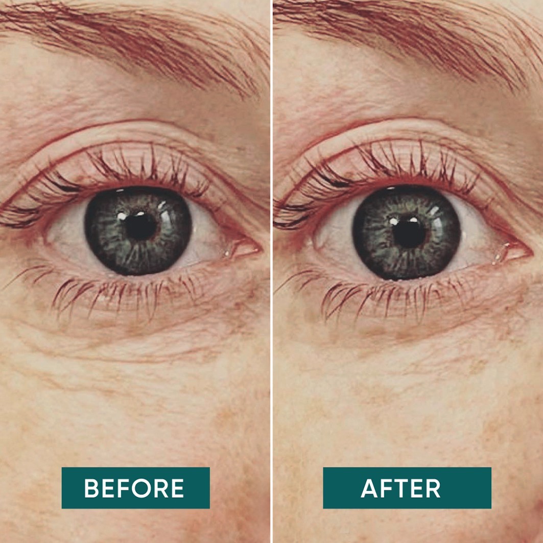 Augen Pads