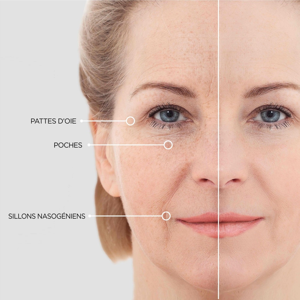 beautical Patchs pour les Yeux aux Micro-aiguilles Agissent pendant que vous dormez