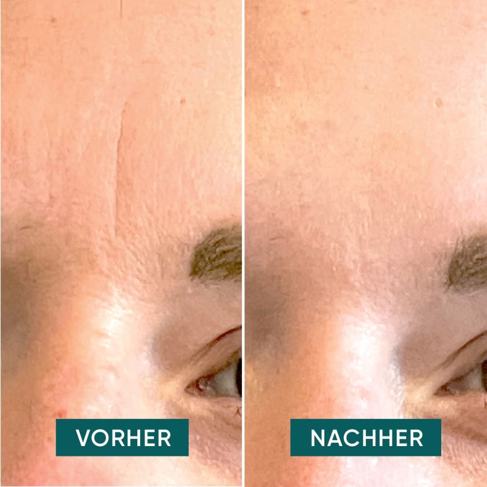 Apricot Beauty Pads Down the Frown & Keep Smiling Patches