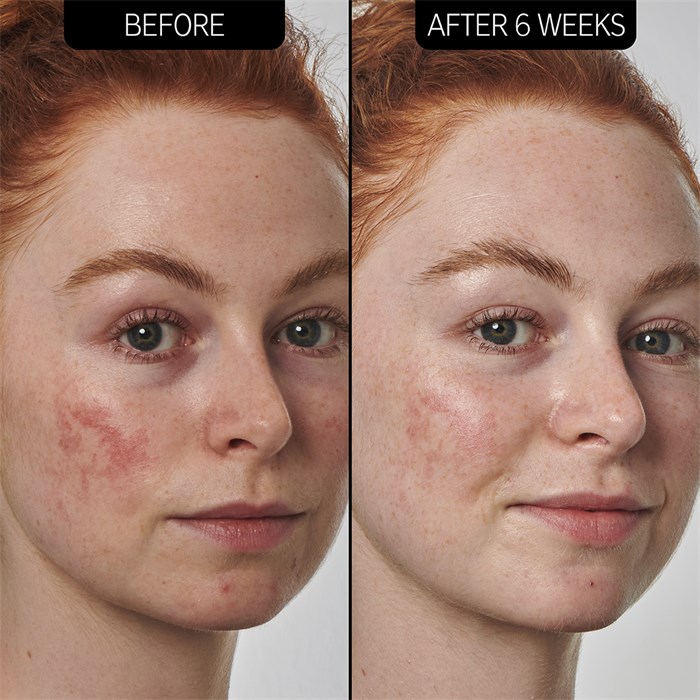 SuperSolutions 10% Azelaic Acid Serum