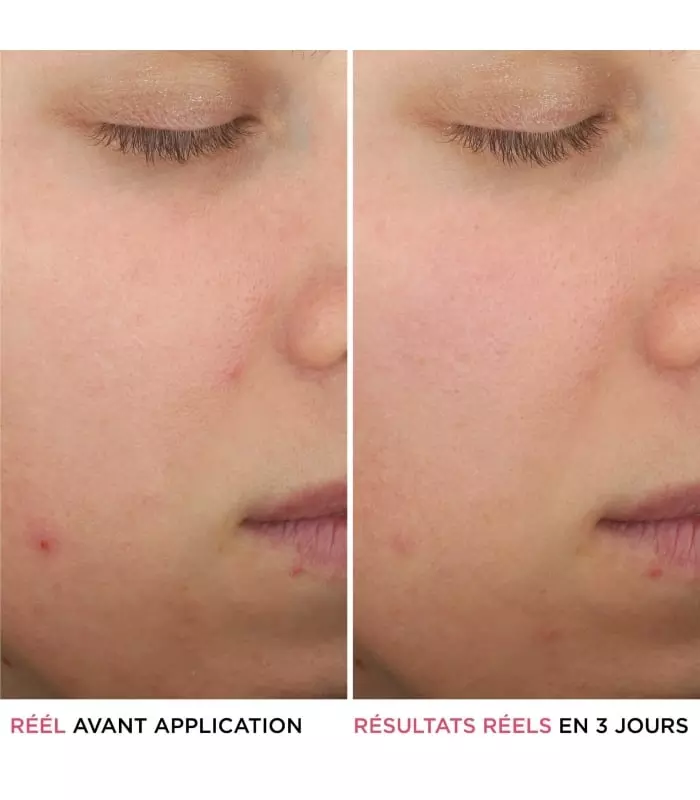 BYE BYE BREAKOUT Sérum anti-acné à l'acide salicylique