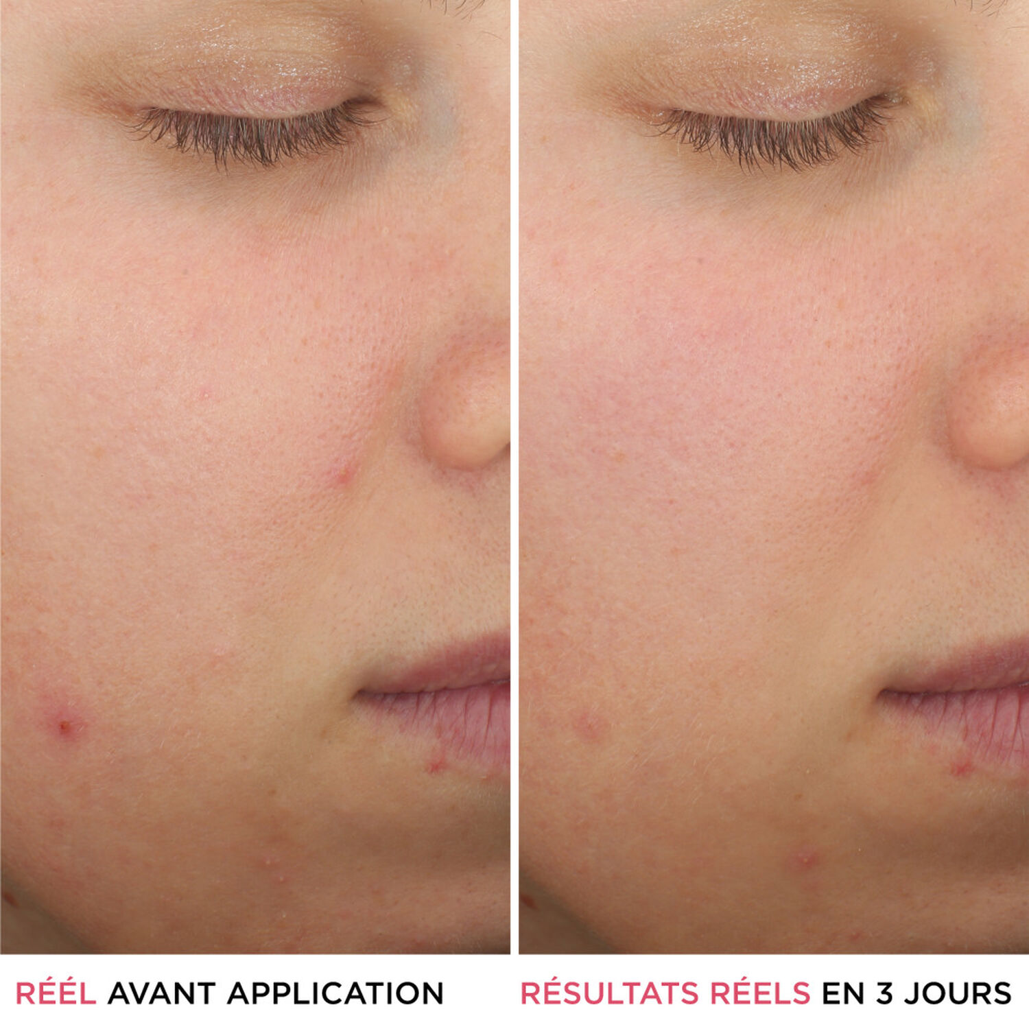 It Cosmetics Bye Bye Breakout Sérum Anti-Acné à l'Acide Salicylique
