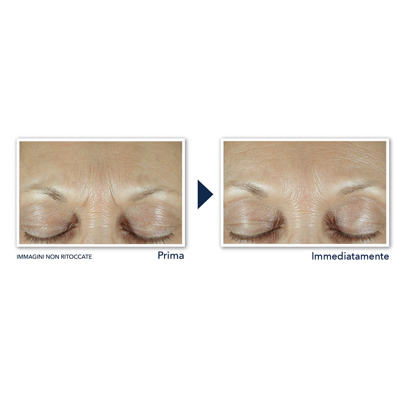 Derm Correxion Fill + Treat Siero - Filler antirughe, Siero viso antirughe