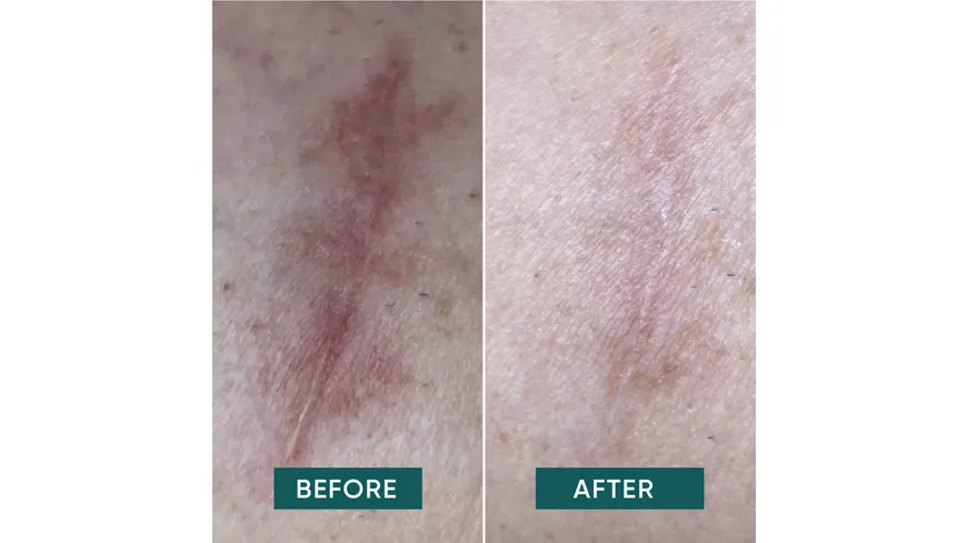 APRICOT Narben Pads klein