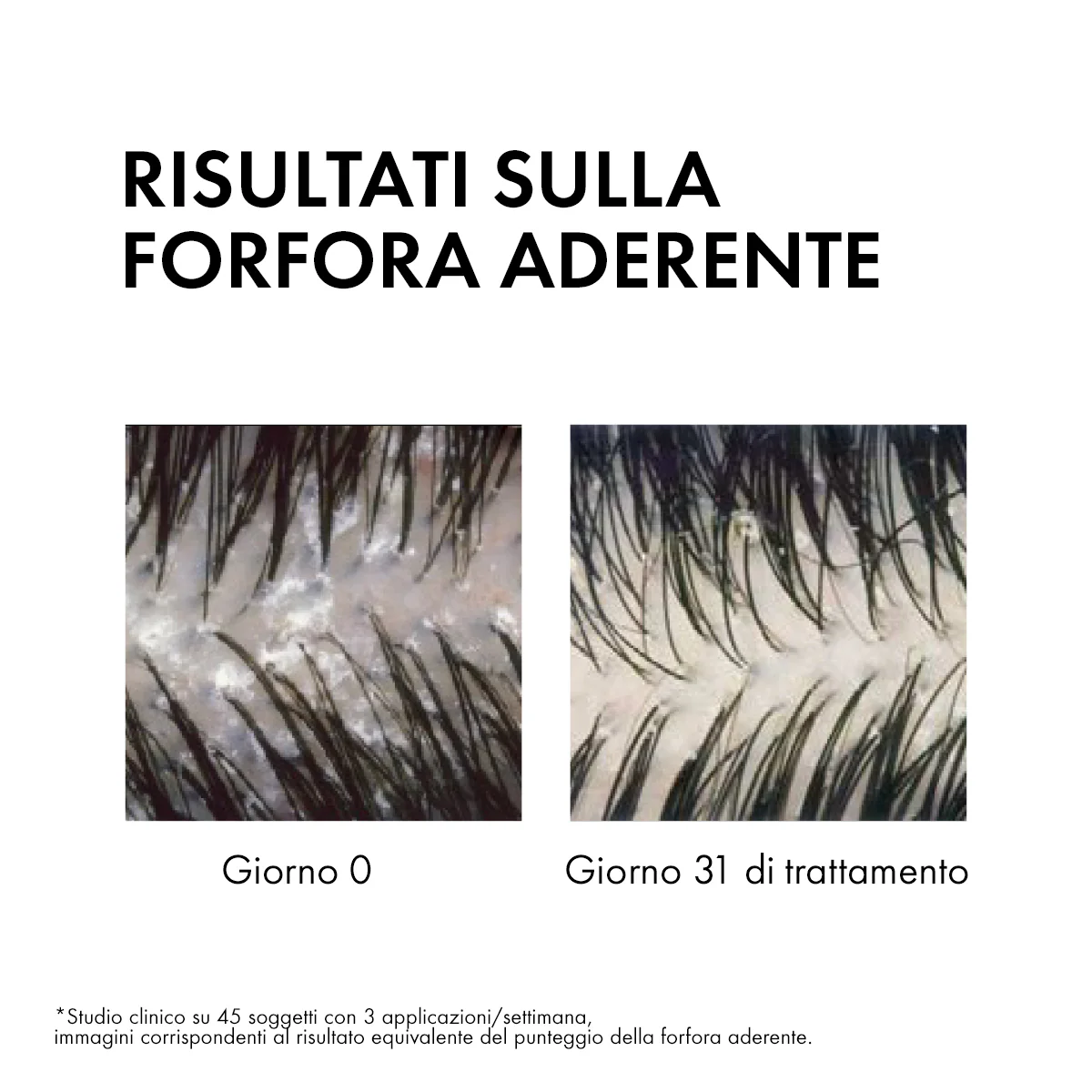 Champú anticaspa Dercos DT DS para cabello normal a graso - Champú anticaspa