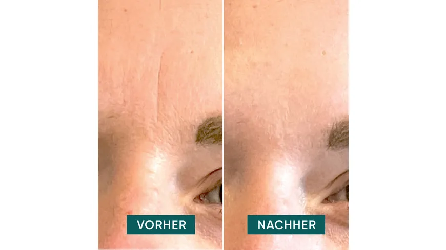 APRICOT Mini Patches Mund und Stirn