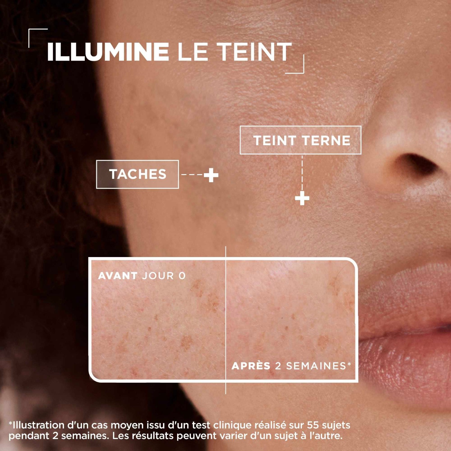 Mixa koncentrirani serum proti temnim madežem