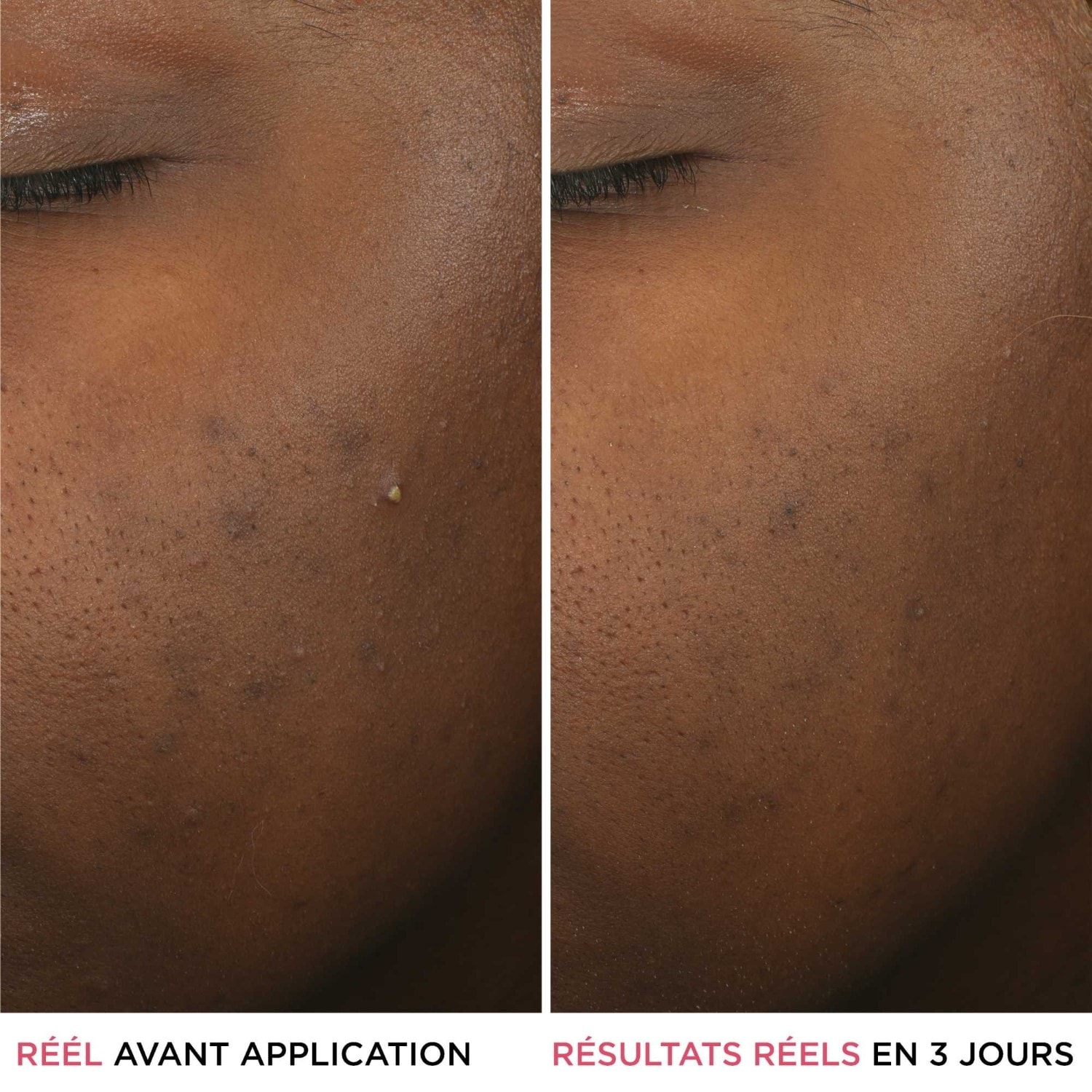 IT Cosmetics Anti-utslettserum med salisylsyre