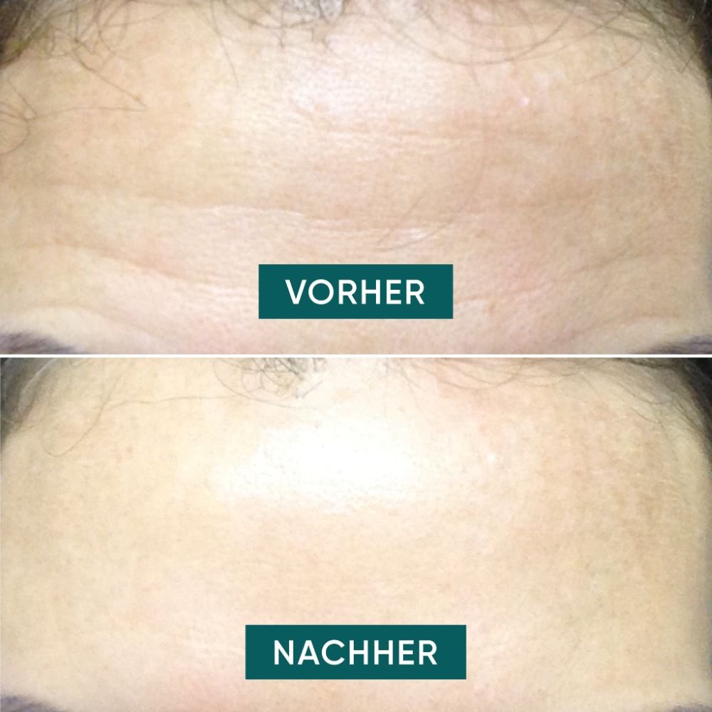 Apricot Beauty Pads Stirn Pad mit Hyaluron