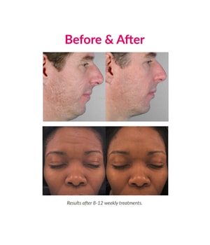 PMD Personal Microderm Elite Pro Black Microdermabrasion-1 Stk
