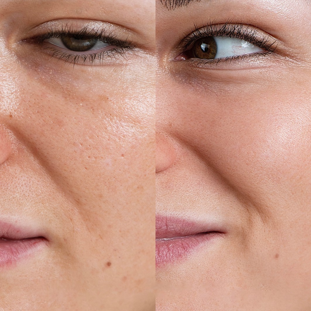 Skin Exfoliating Peeling