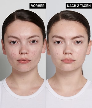 The INKEY List Succinic Acid Treatment Gesichtskur-15 ml