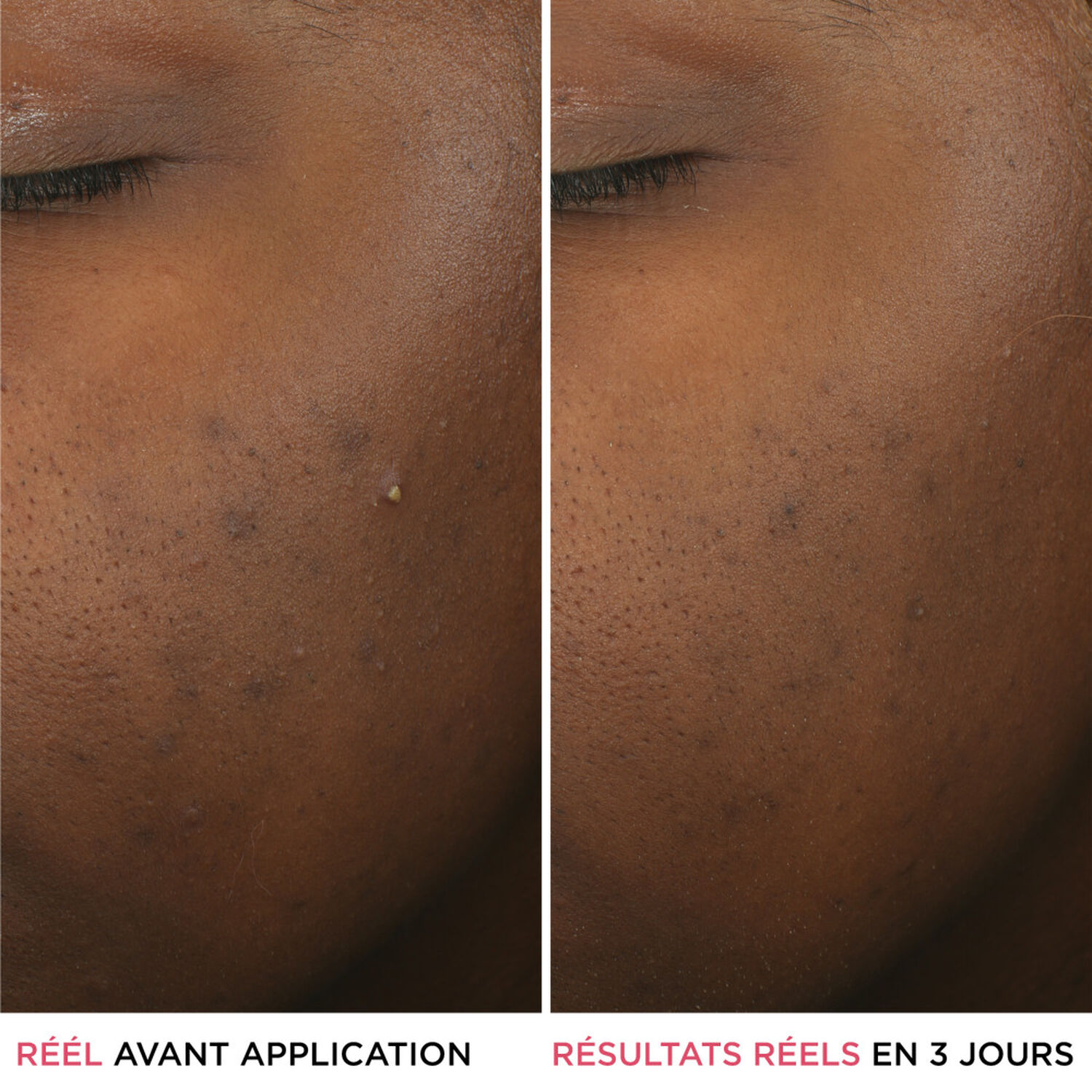 It Cosmetics Bye Bye Breakout Sérum Anti-Acné à l'Acide Salicylique