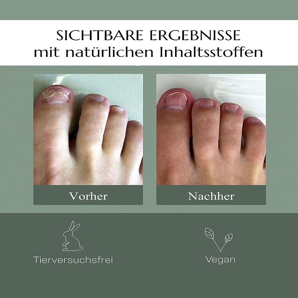 Sarfly Nagelpflege-Set Nail Care Pen, Kosmetische Pflege bei Nagelpilzinfektion, 1-tlg.