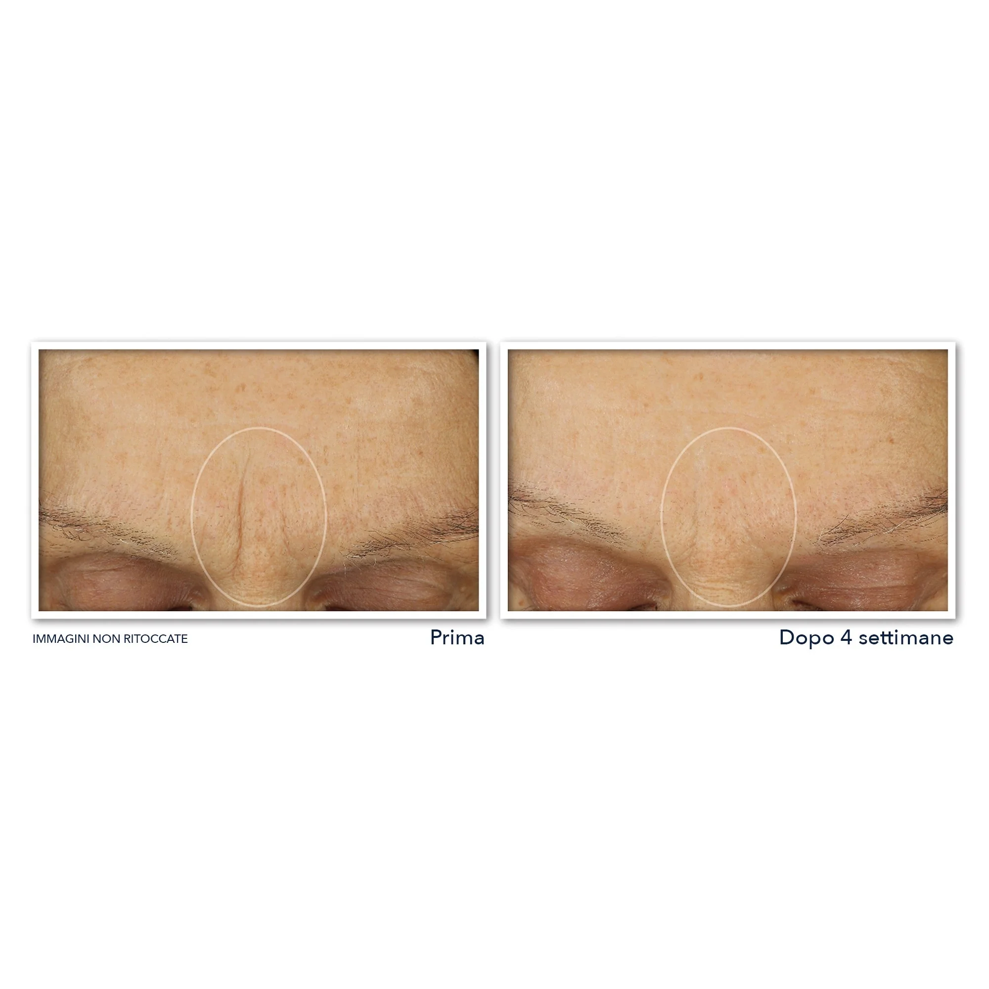Creme facial suavizante de linhas de expressão com retinol Correxion - Hidratação máxima - Tratamento facial antirrugas de 24 horas