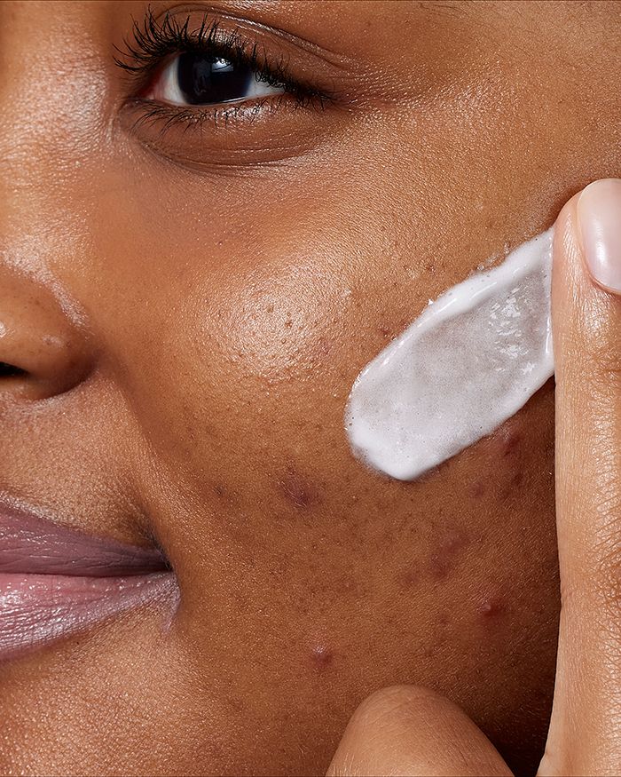 Crème nettoyante moussante anti-acné à 10 % de peroxyde de benzoyle pour le visage et le corps