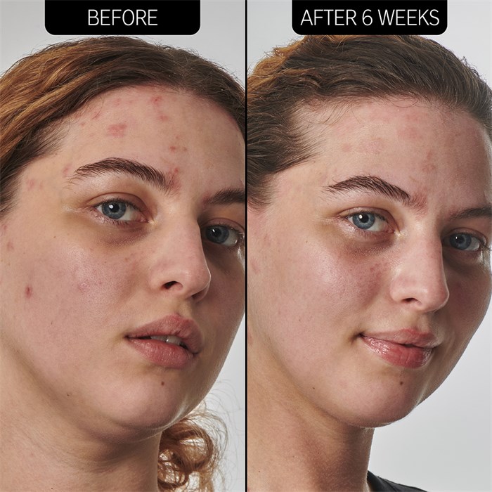 SuperSolutions 10% Urea Moisturizer