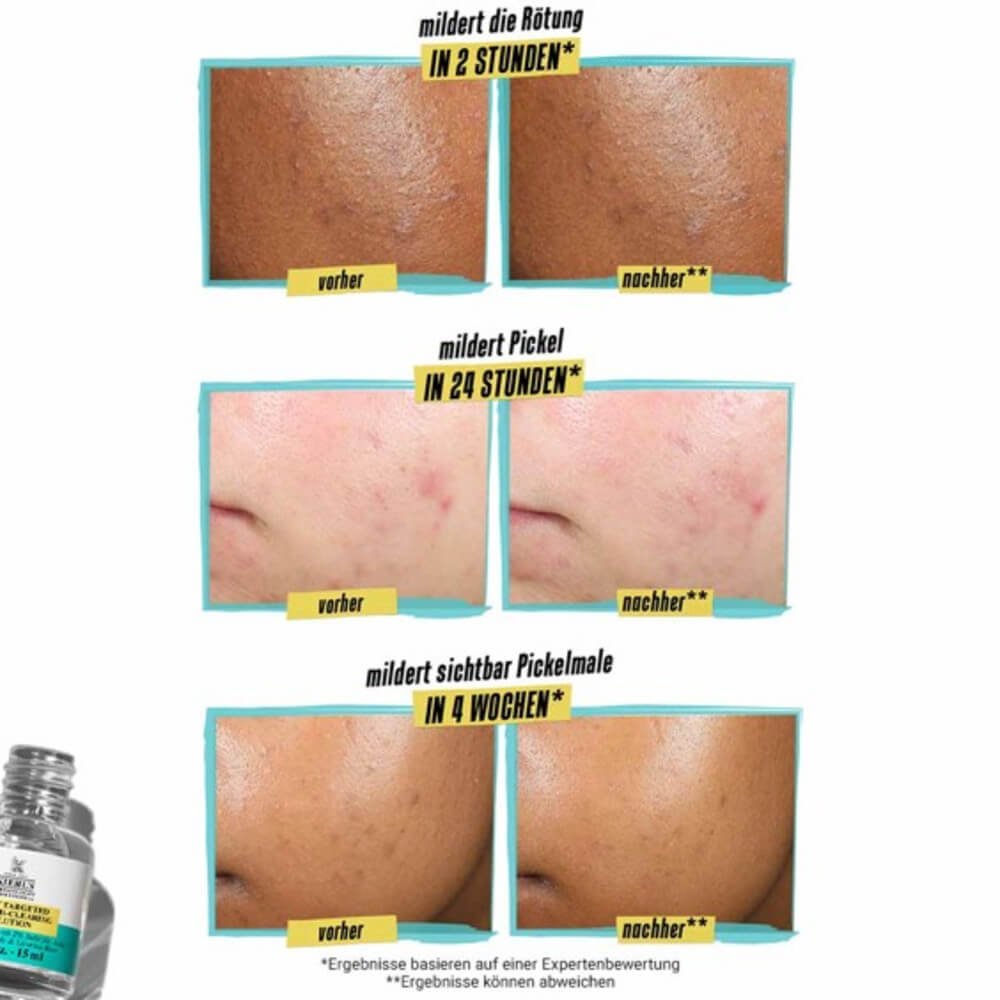 KIEHL&'S ACNE Spot Treatment