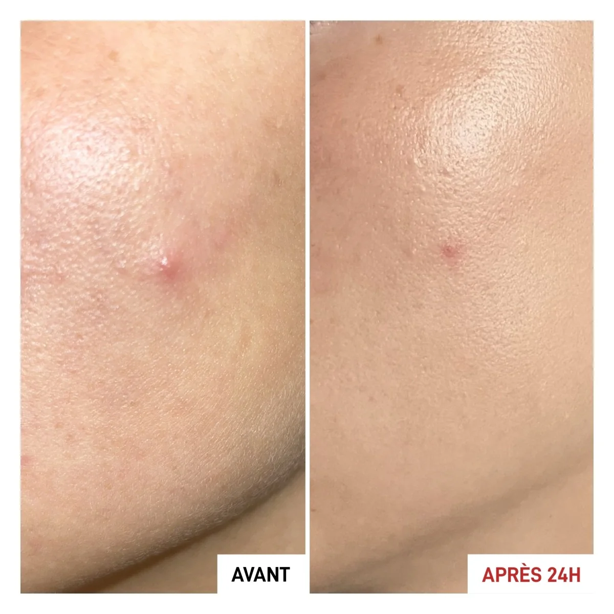 Centella Asiatica Centella SOS Patch - soro facial anti-manchas, tratamento facial anti-manchas 24 horas