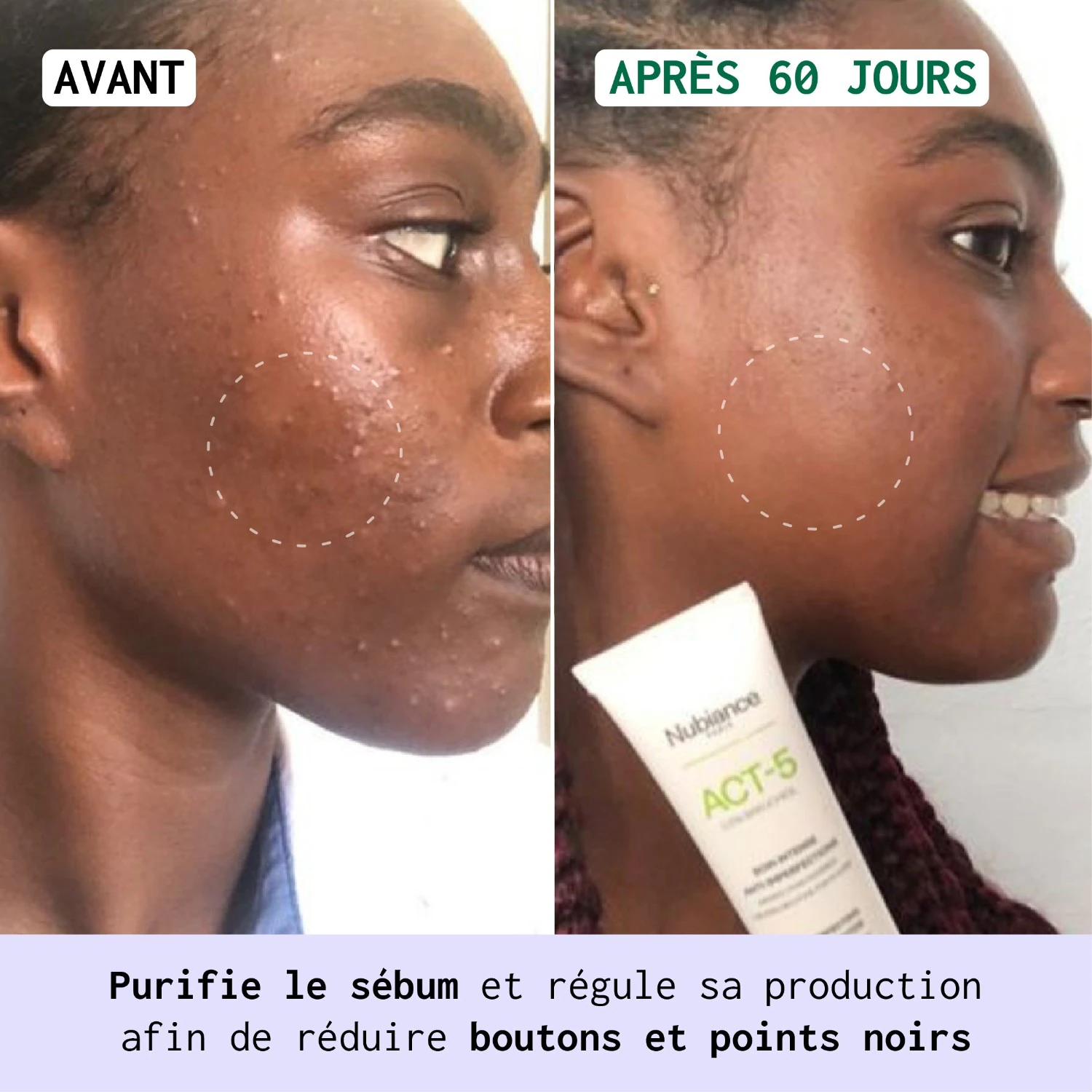 Nubiance ACT-5® - Intensiv pleie mot urenheter