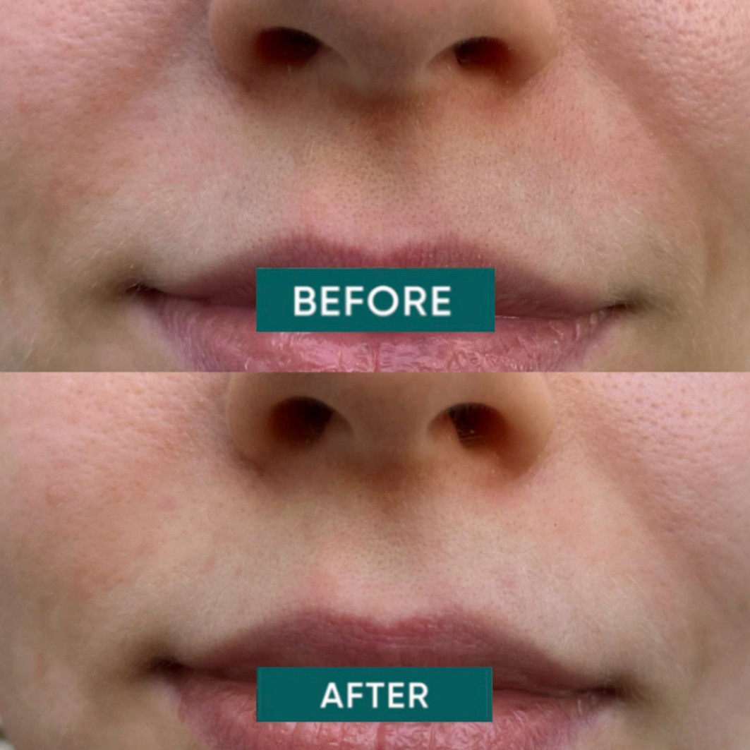 Keep Smiling Mouth Patches