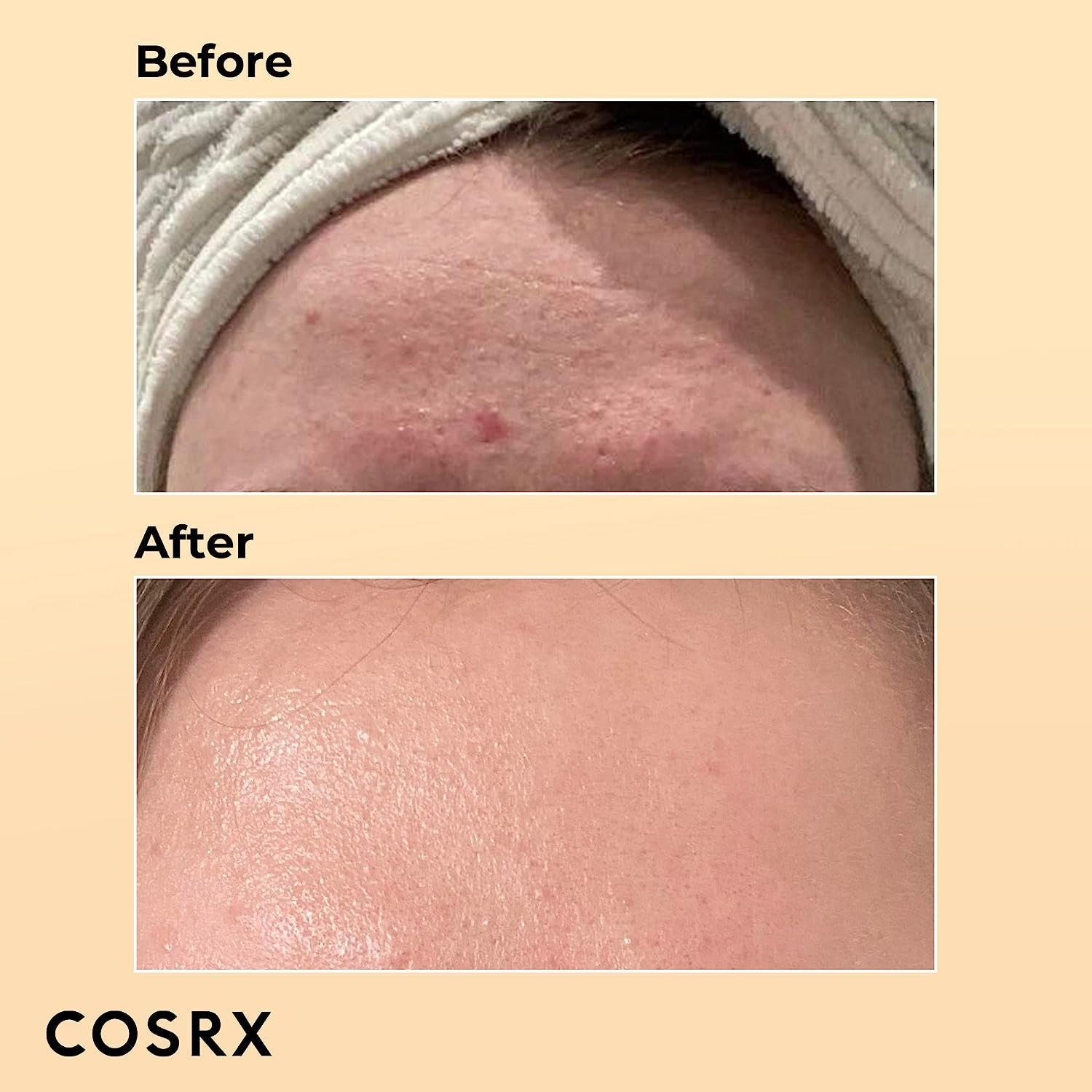 Cosrx Gesichtsserum Advanced Snail Power Essence 100ml Gesichtsserum Schneckenschleim Gesichtscreme, Creme Pickelentferner Akne Behandlung, Pickel Entferner, 1-tlg., Hochdosiert, für unreine und empfindliche Haut, Anti Pickel Serum