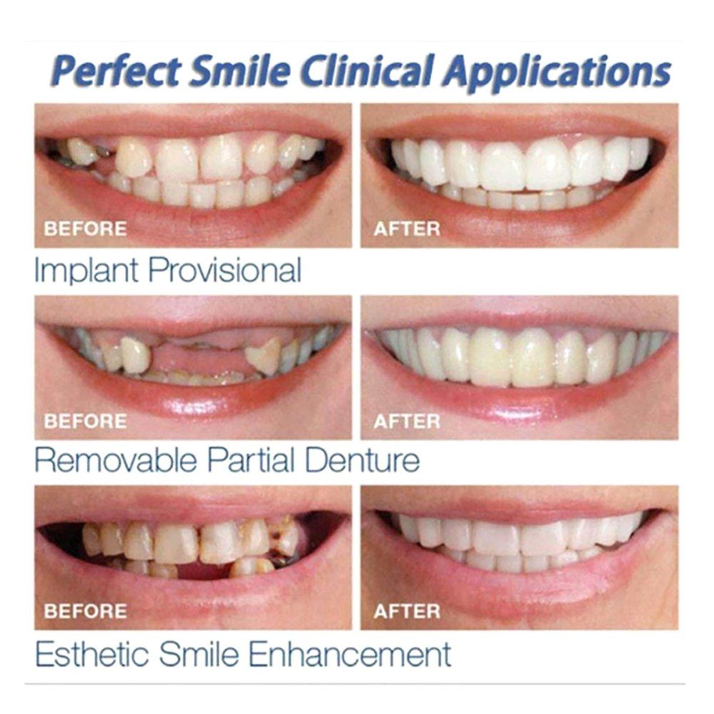 Orbeet Mundpflegecenter Snap On Veneers Kosmetische Zahnblende Comfort Prothese Falsche Zähne