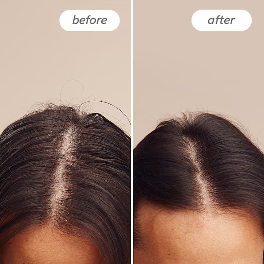 Šampón proti lupinám Hairlust