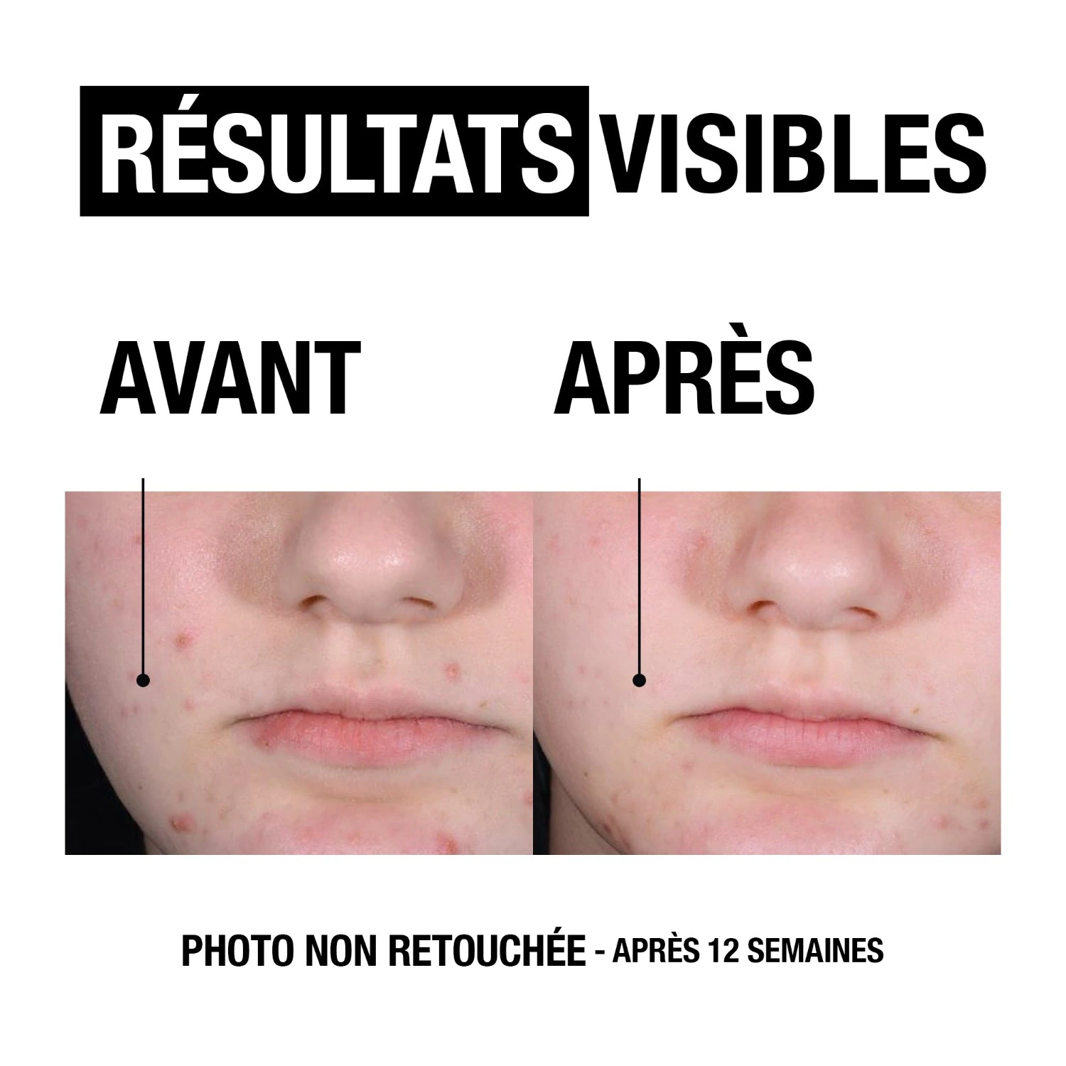 Neutrogena Gel Anti-Pete + Hidratant Niacinamidă + Pantenol