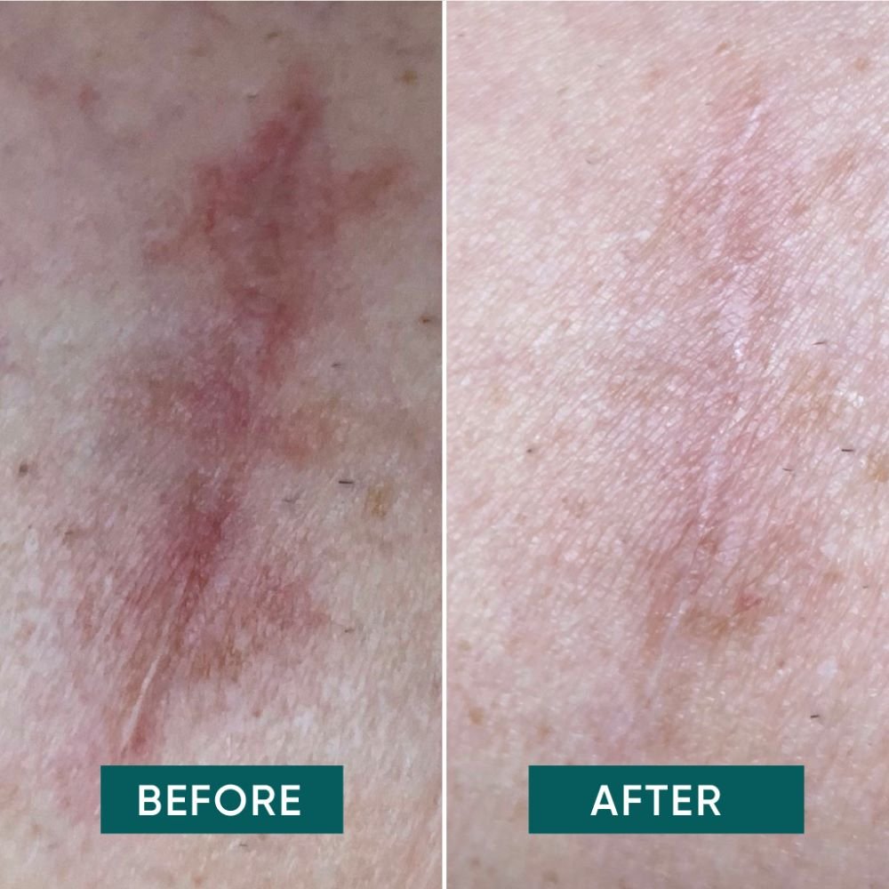 Apricot Healthcare Scar scar away